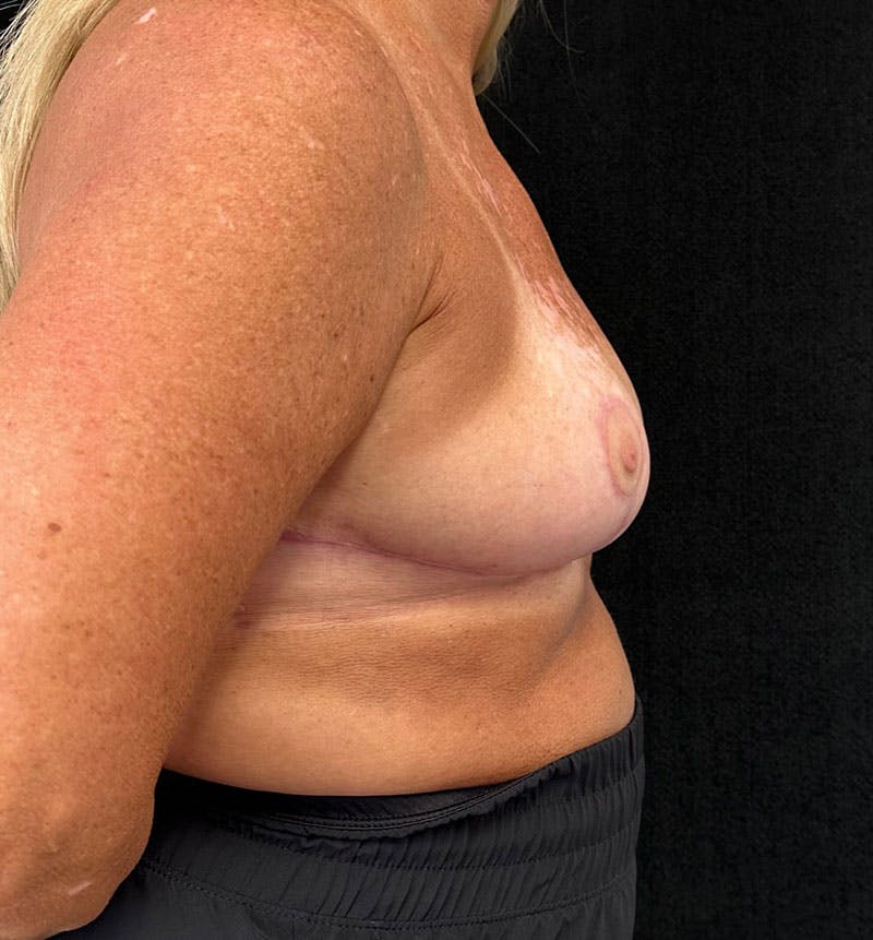 Breast Reduction Before & After Gallery - Patient 163002805 - Image 8