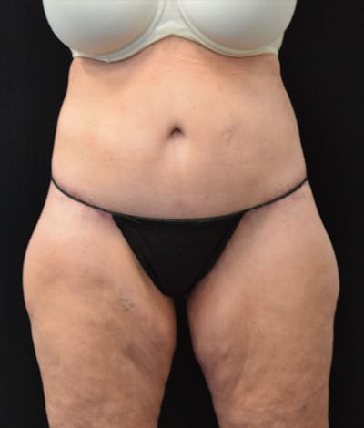 Lower Body Lift Before & After Gallery - Patient 163401900 - Image 2
