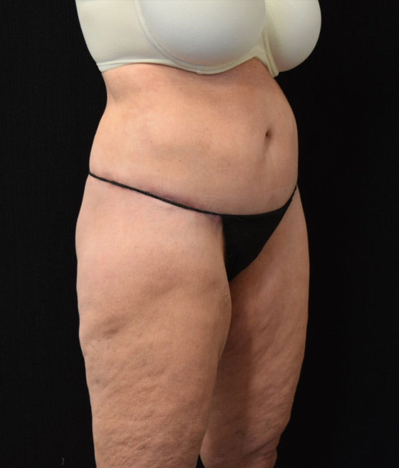 Lower Body Lift Before & After Gallery - Patient 163401900 - Image 4