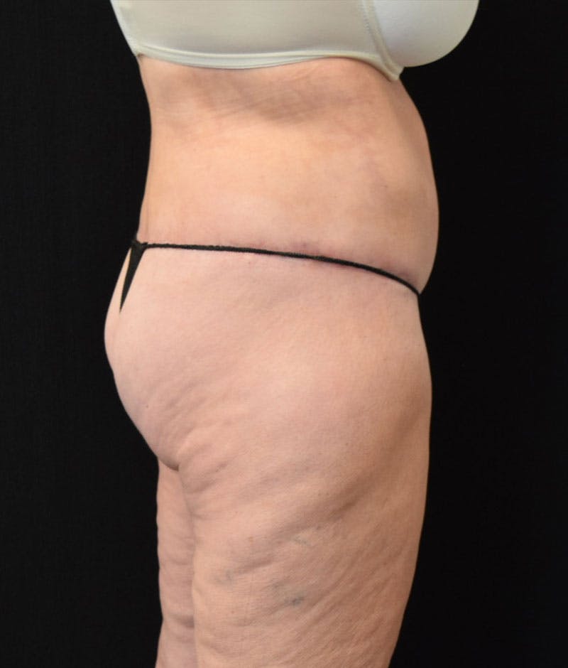 Lower Body Lift Before & After Gallery - Patient 163401900 - Image 6
