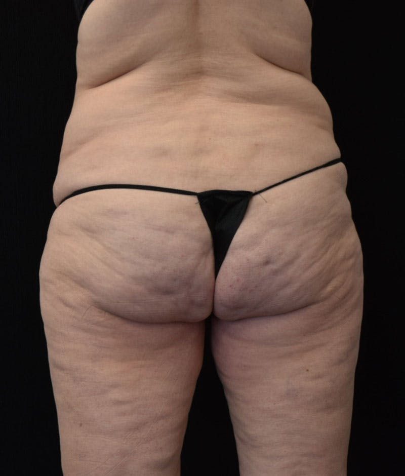 Lower Body Lift Before & After Gallery - Patient 163401900 - Image 7