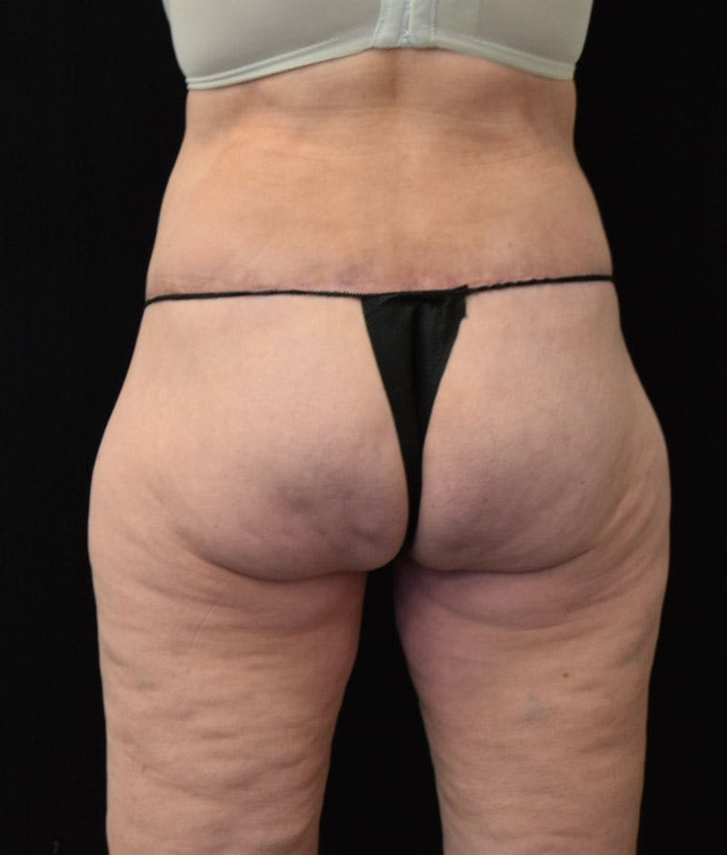 Lower Body Lift Before & After Gallery - Patient 163401900 - Image 8