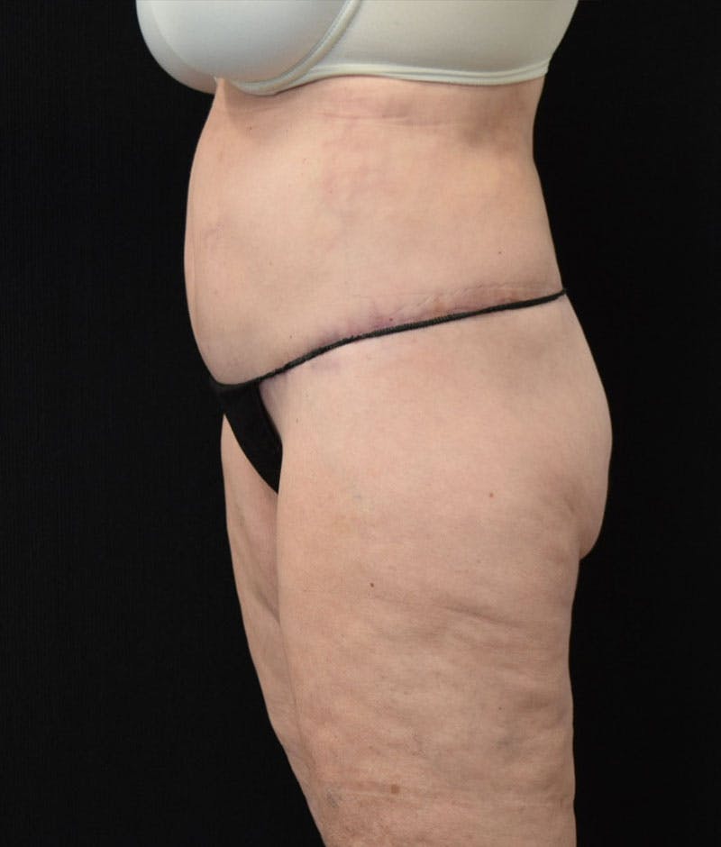 Lower Body Lift Before & After Gallery - Patient 163401900 - Image 10