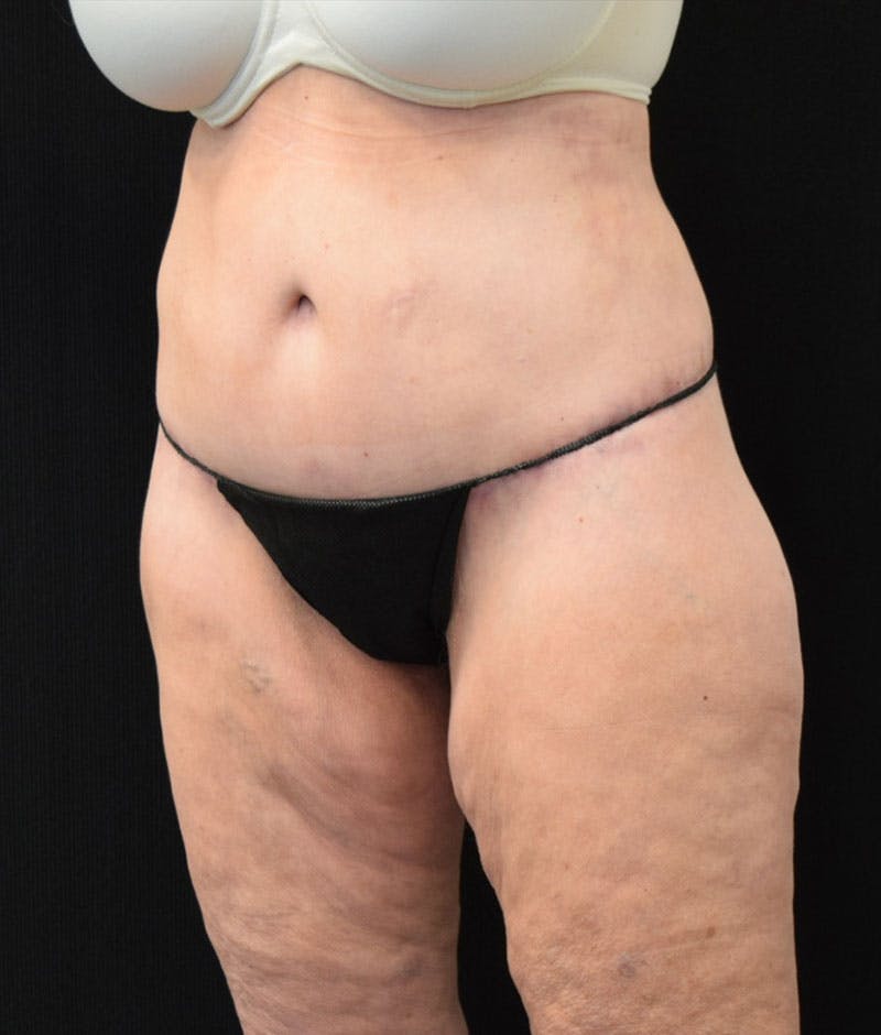 Lower Body Lift Before & After Gallery - Patient 163401900 - Image 12