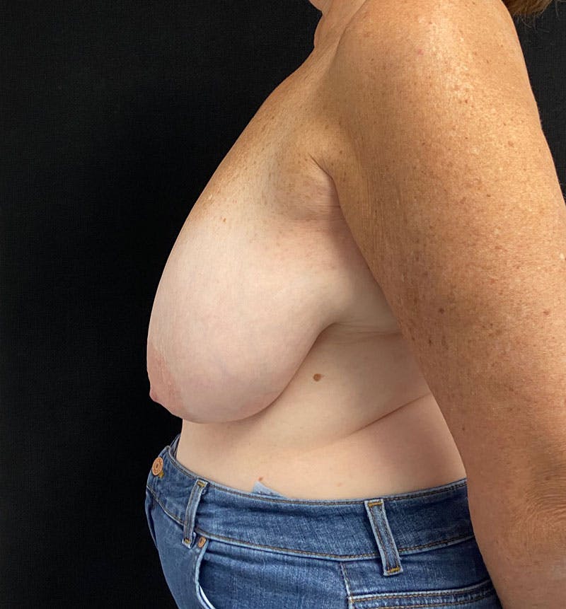 Breast Reduction Before & After Gallery - Patient 163402967 - Image 5