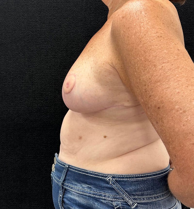 Breast Reduction Before & After Gallery - Patient 163402967 - Image 6