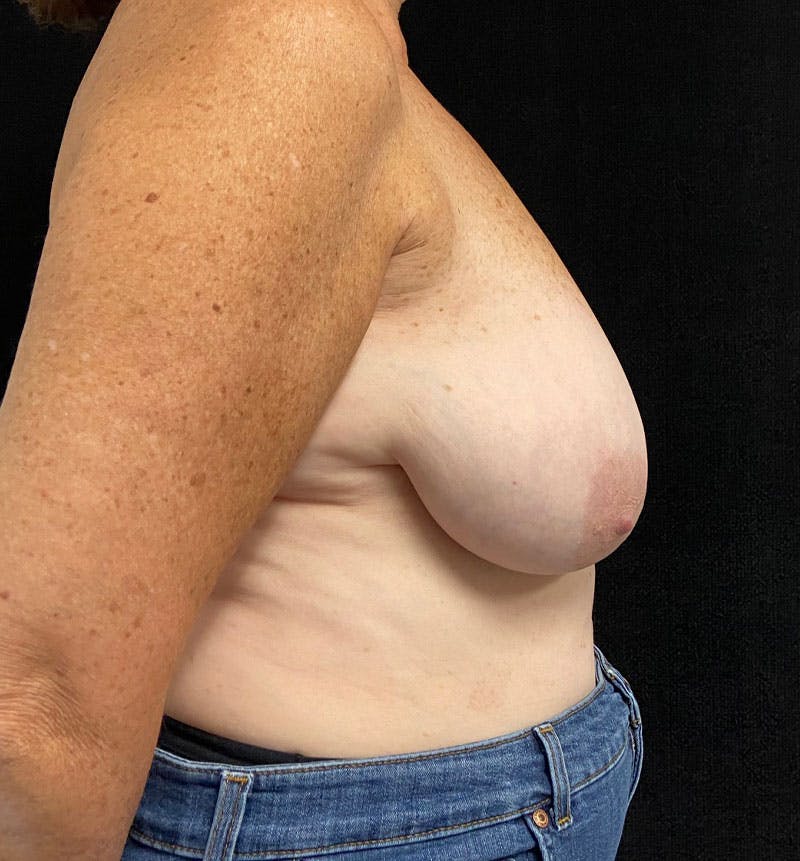 Breast Reduction Before & After Gallery - Patient 163402967 - Image 7