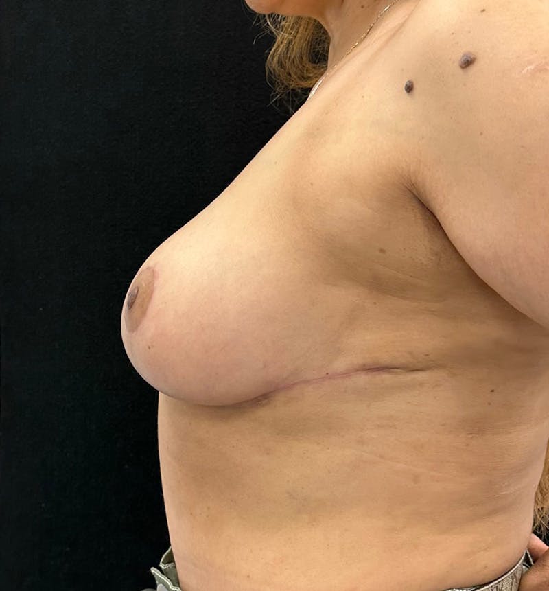 Breast Reduction Before & After Gallery - Patient 176809144 - Image 10