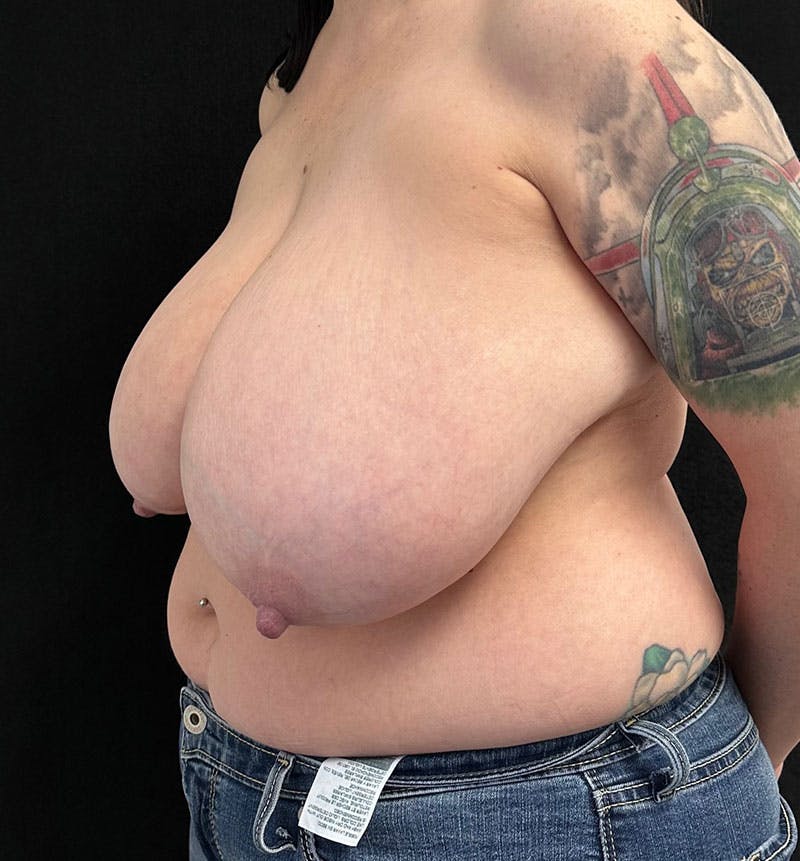 Breast Reduction Before & After Gallery - Patient 178939539 - Image 3