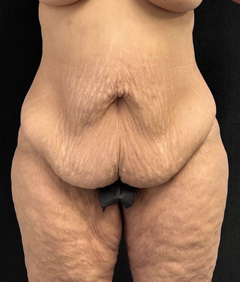 Lower Body Lift Before & After Gallery - Patient 188499690 - Image 1