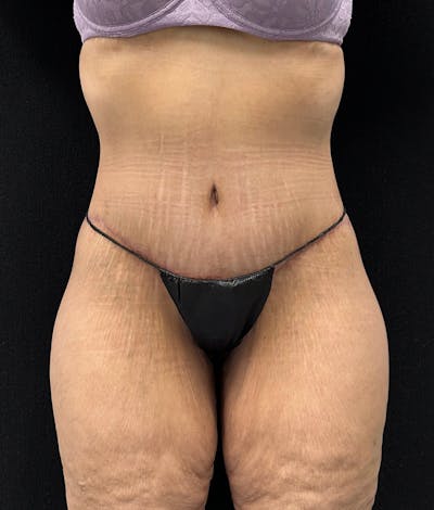 Lower Body Lift Before & After Gallery - Patient 188499690 - Image 2