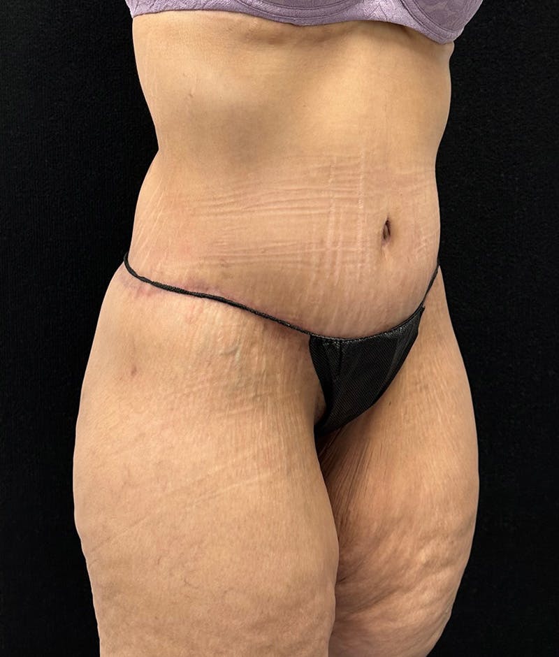 Lower Body Lift Before & After Gallery - Patient 188499690 - Image 4
