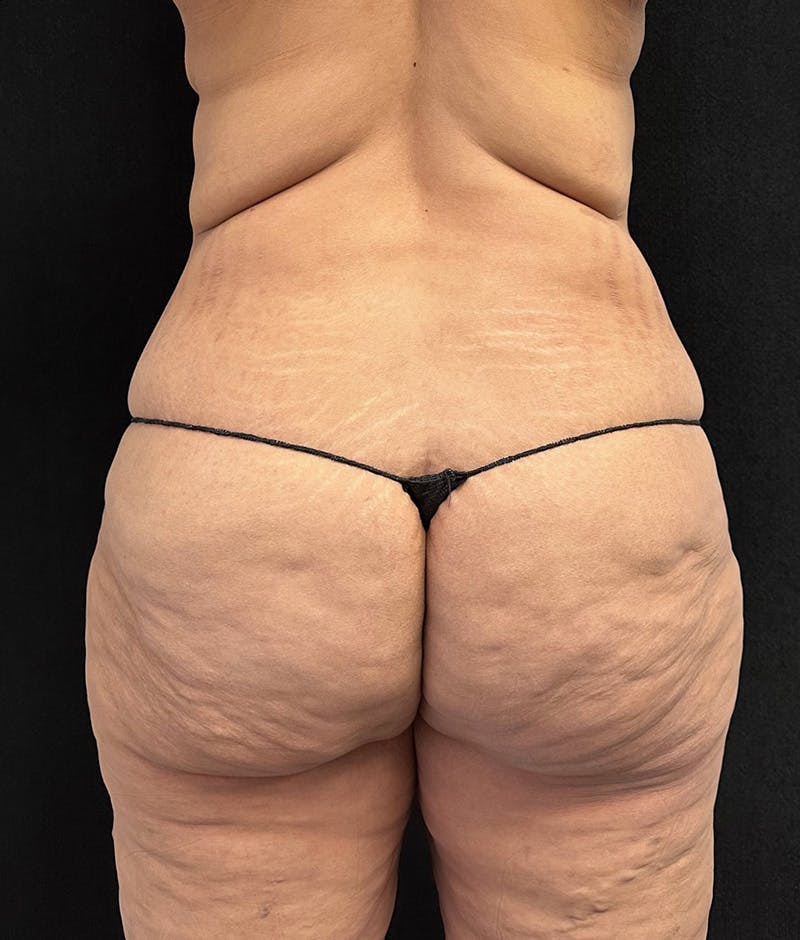Lower Body Lift Before & After Gallery - Patient 188499690 - Image 7