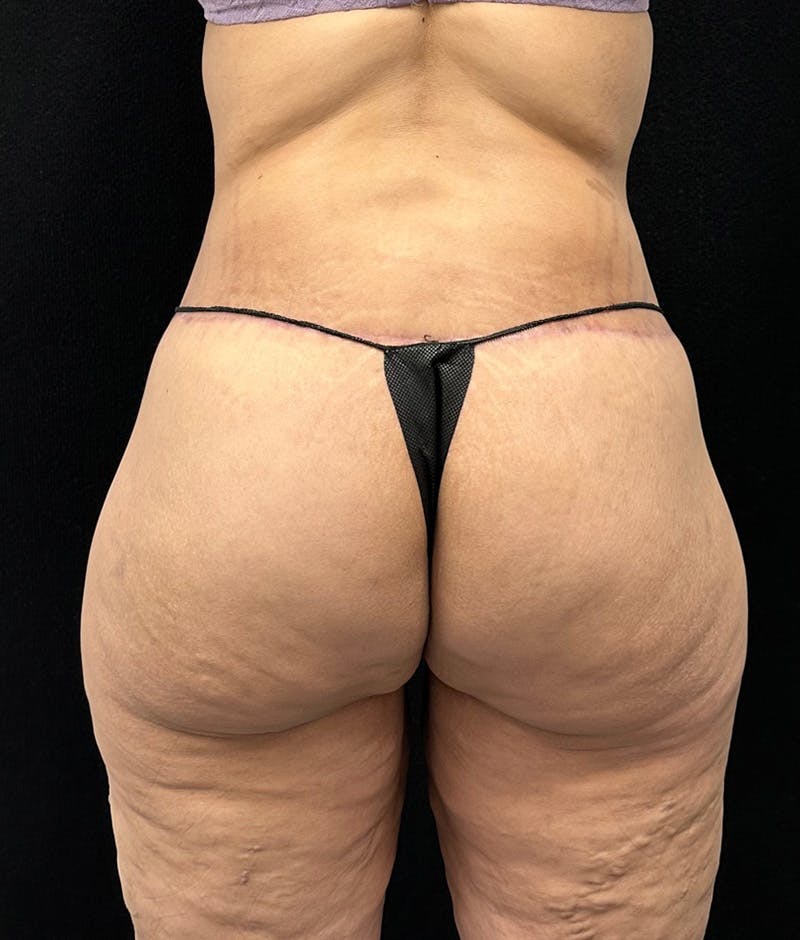 Lower Body Lift Before & After Gallery - Patient 188499690 - Image 8
