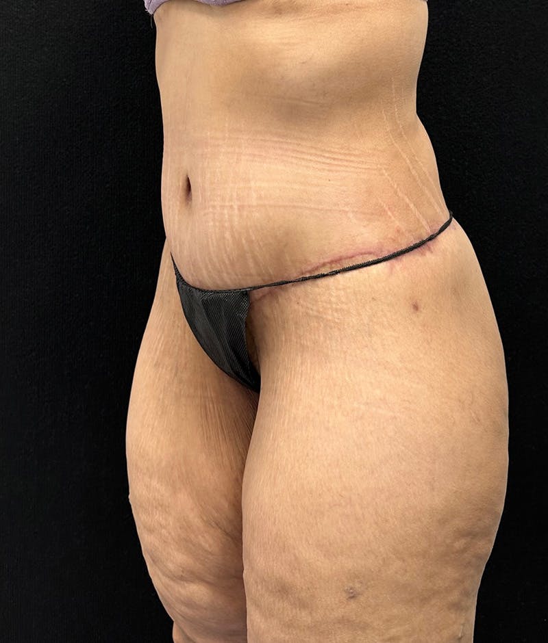 Lower Body Lift Before & After Gallery - Patient 188499690 - Image 10