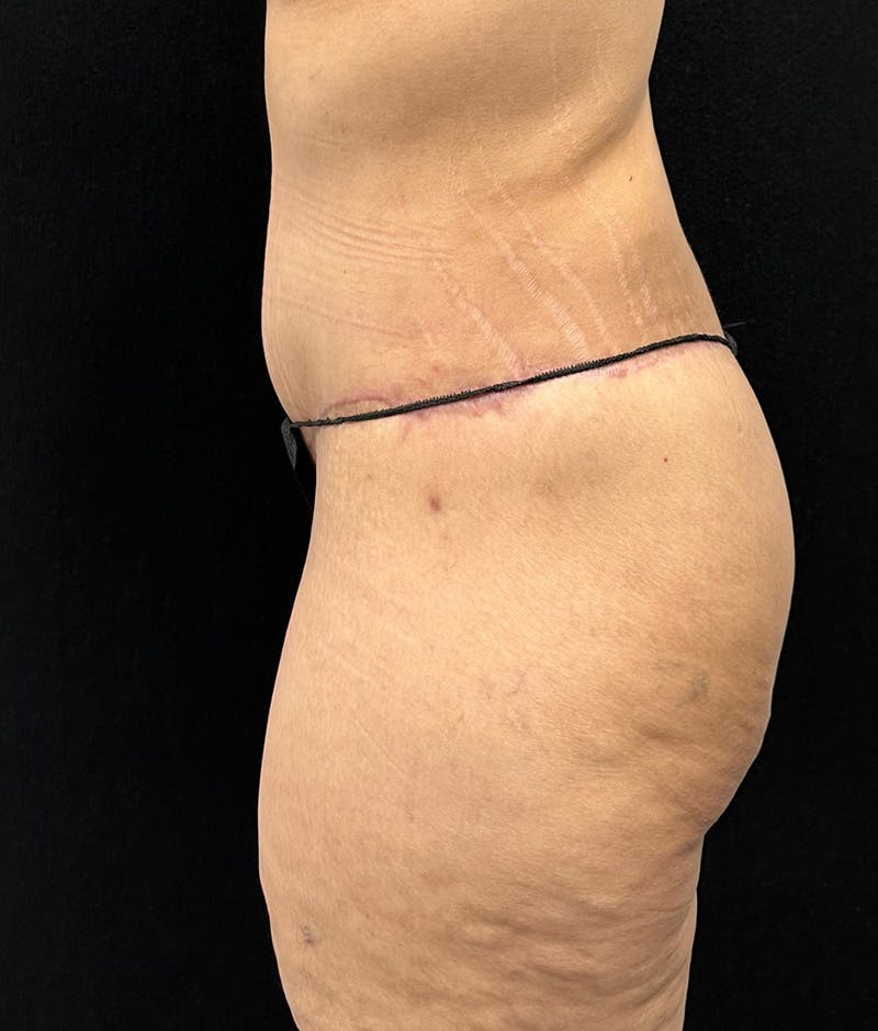 Lower Body Lift Before & After Gallery - Patient 188499690 - Image 12