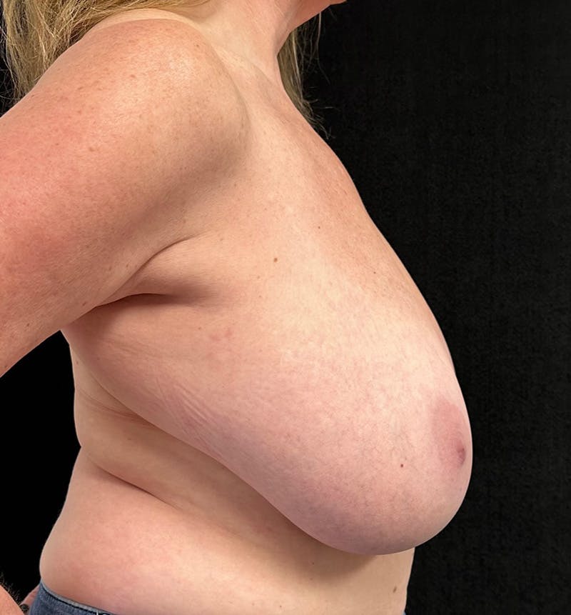 Breast Reduction Before & After Gallery - Patient 328234 - Image 5