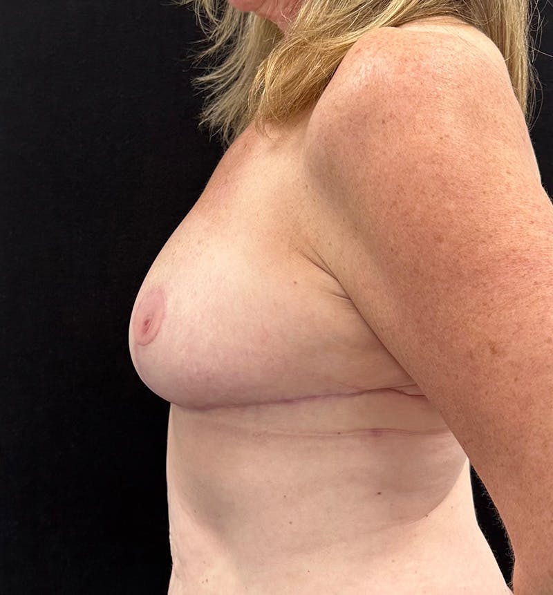 Breast Reduction Before & After Gallery - Patient 328234 - Image 10
