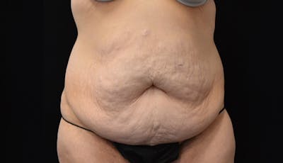 Abdominoplasty Before & After Gallery - Patient 599644 - Image 1