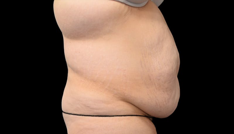 Abdominoplasty Before & After Gallery - Patient 599644 - Image 5