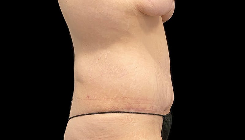Abdominoplasty Before & After Gallery - Patient 599644 - Image 6