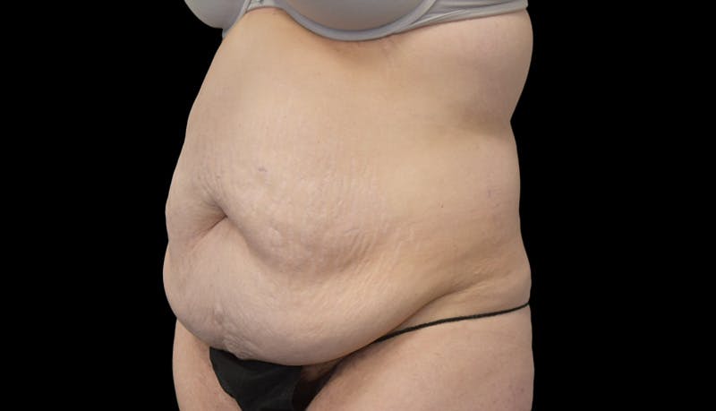 Abdominoplasty Before & After Gallery - Patient 599644 - Image 7
