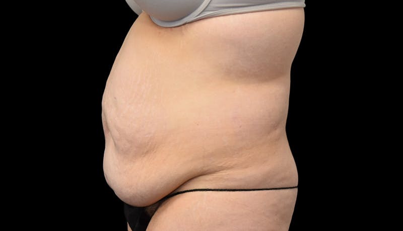 Abdominoplasty Before & After Gallery - Patient 599644 - Image 9