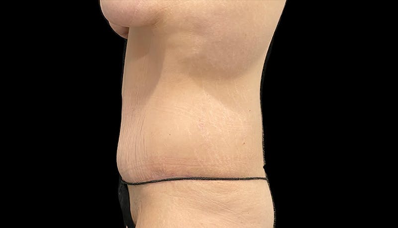 Abdominoplasty Before & After Gallery - Patient 599644 - Image 10