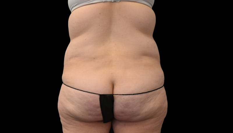 Abdominoplasty Before & After Gallery - Patient 599644 - Image 11