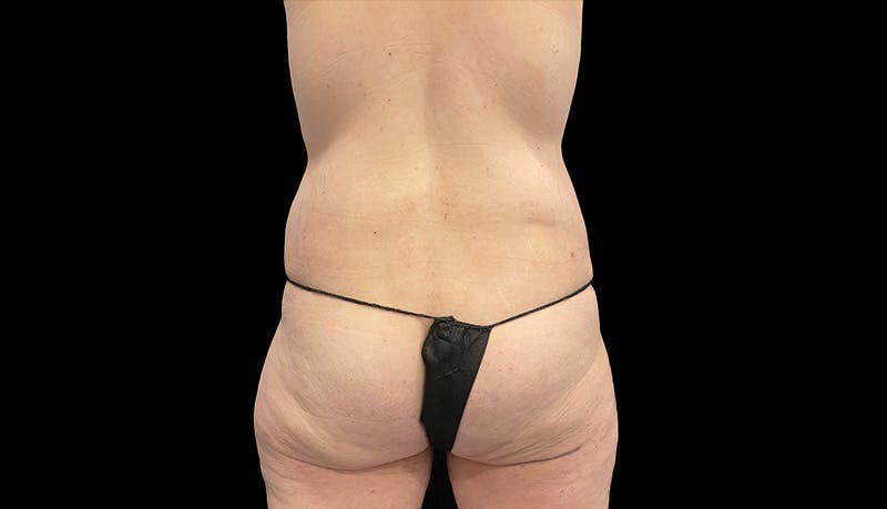 Abdominoplasty Before & After Gallery - Patient 599644 - Image 12