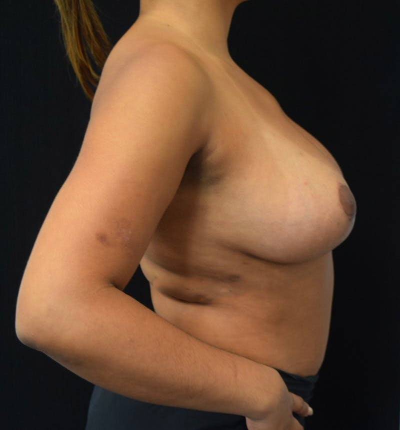 Breast Reduction Before & After Gallery - Patient 108858 - Image 6