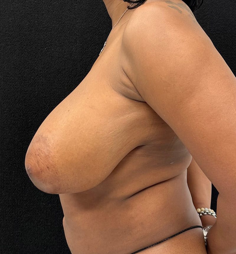 Breast Reduction Before & After Gallery - Patient 211798 - Image 9