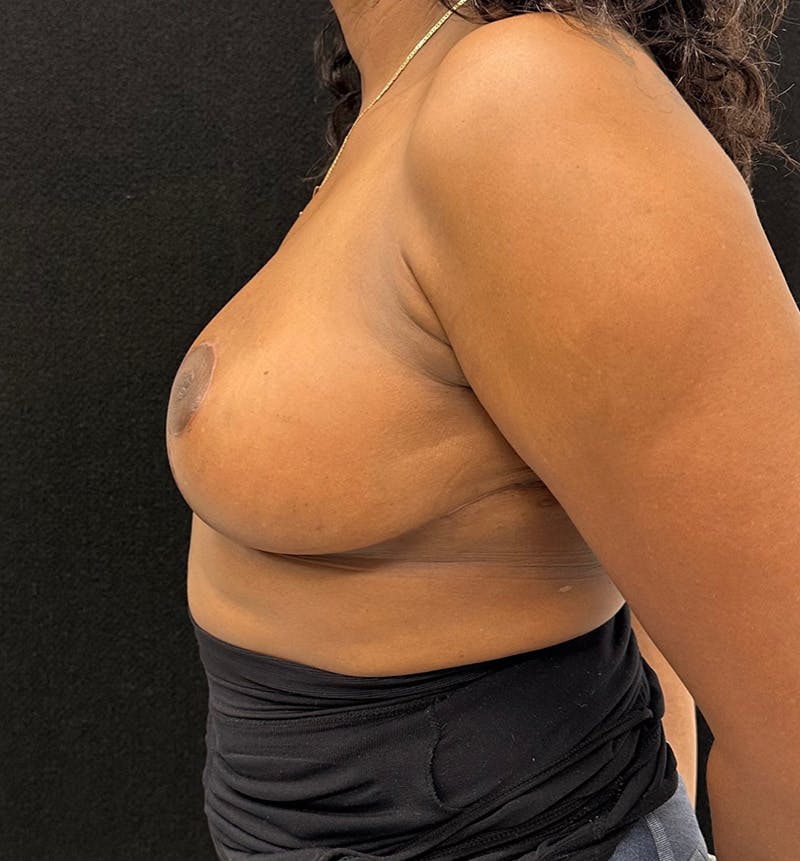 Breast Reduction Before & After Gallery - Patient 211798 - Image 10