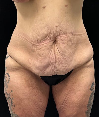 Lower Body Lift Before & After Gallery - Patient 159846 - Image 1