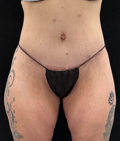 Lower Body Lift Before & After Gallery - Patient 159846 - Image 2
