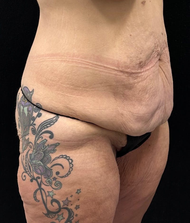 Lower Body Lift Before & After Gallery - Patient 159846 - Image 3