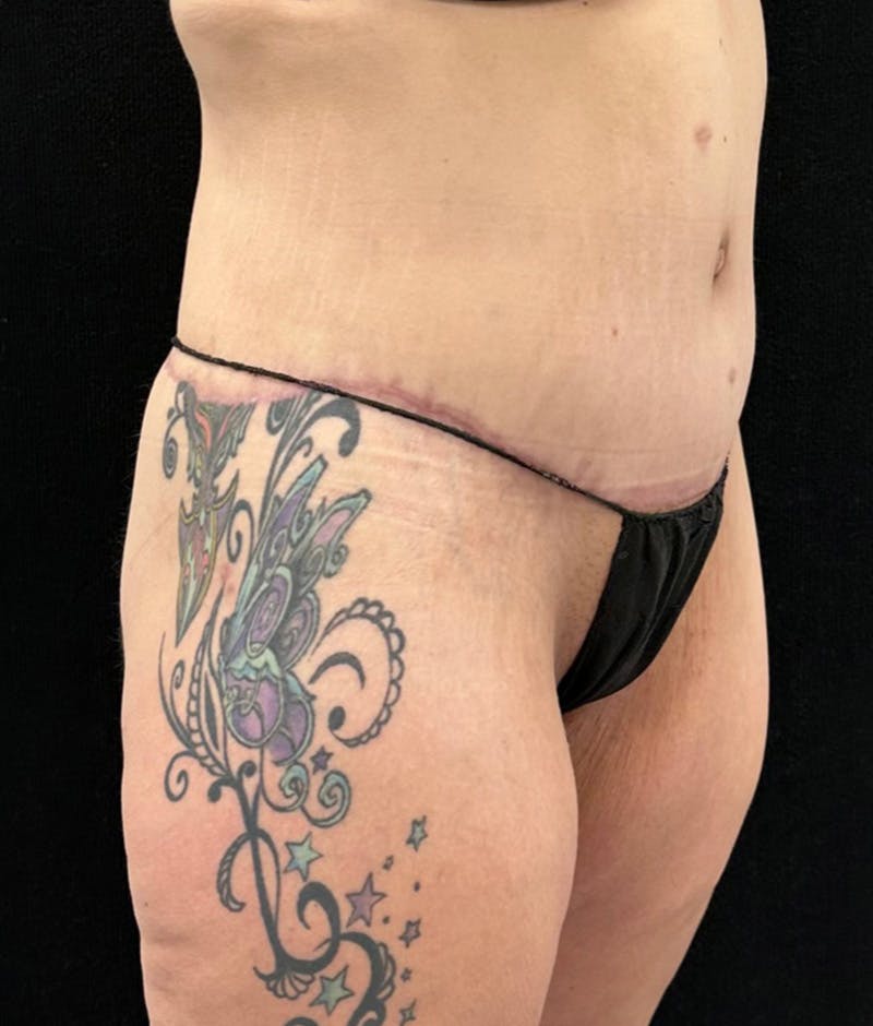 Lower Body Lift Before & After Gallery - Patient 159846 - Image 4