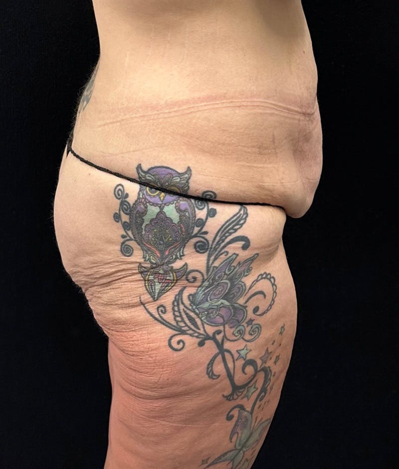 Lower Body Lift Before & After Gallery - Patient 159846 - Image 5