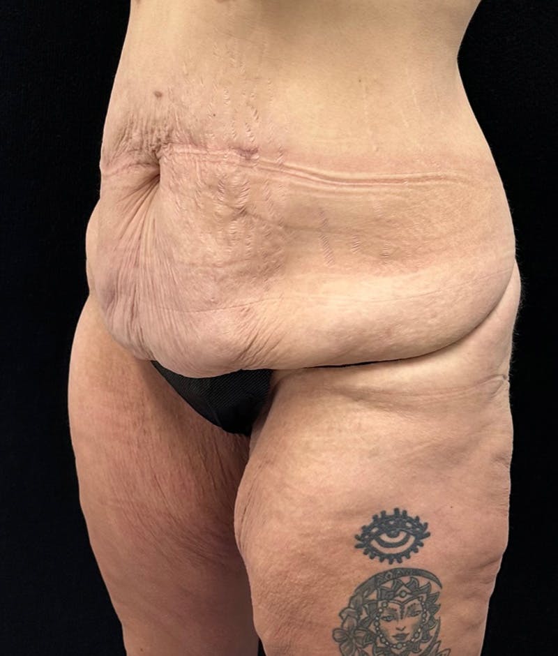 Lower Body Lift Before & After Gallery - Patient 159846 - Image 7