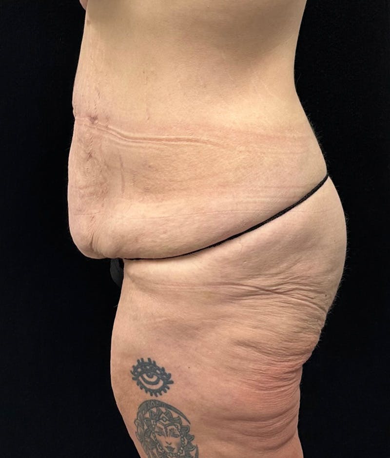 Lower Body Lift Before & After Gallery - Patient 159846 - Image 9