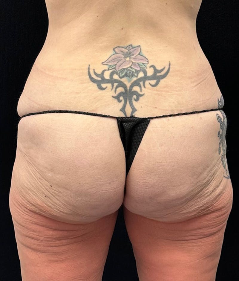 Lower Body Lift Before & After Gallery - Patient 159846 - Image 11