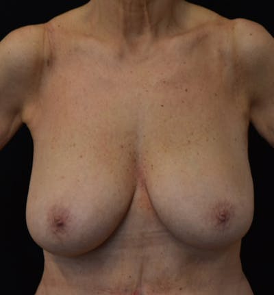 Breast Reduction Before & After Gallery - Patient 178803 - Image 1