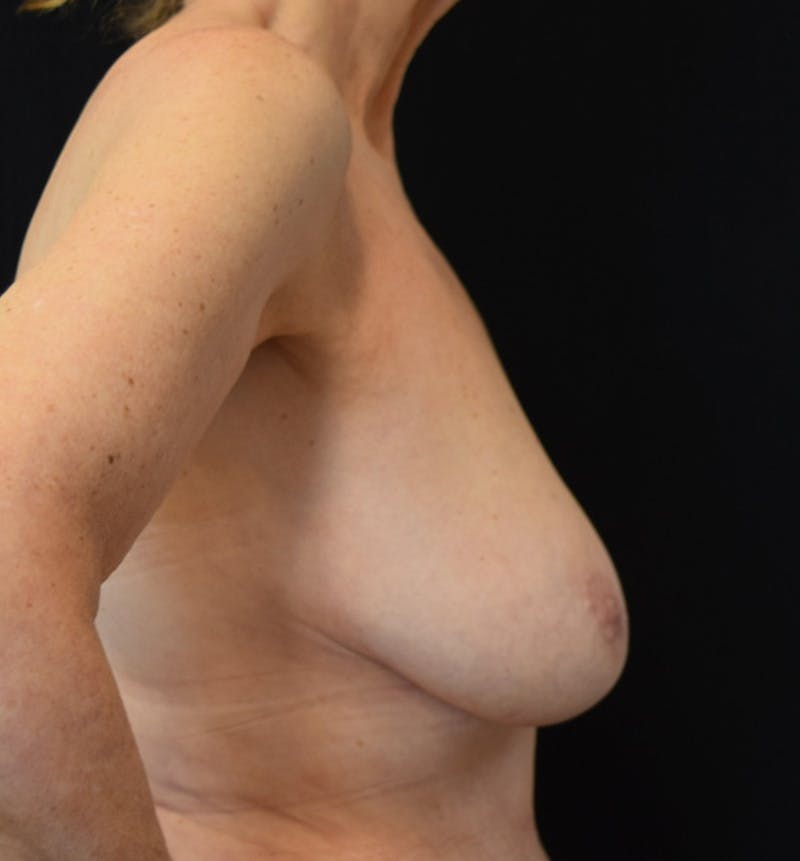 Breast Reduction Before & After Gallery - Patient 178803 - Image 5