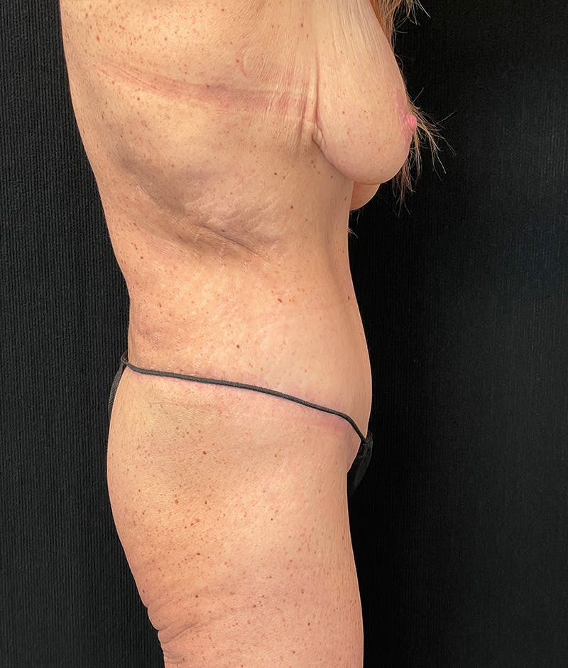 Lower Body Lift Before & After Gallery - Patient 401679 - Image 6