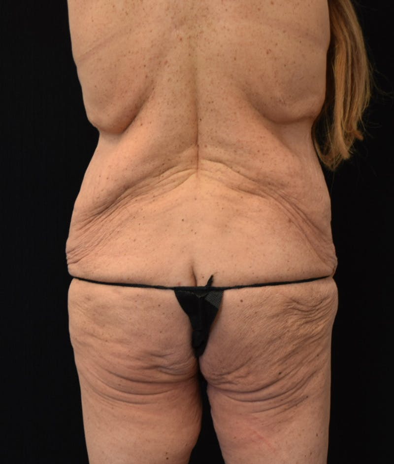 Lower Body Lift Before & After Gallery - Patient 401679 - Image 11