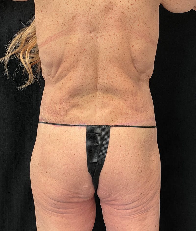 Lower Body Lift Before & After Gallery - Patient 401679 - Image 12