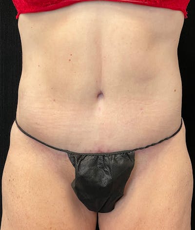 Lower Body Lift Before & After Gallery - Patient 210875 - Image 2