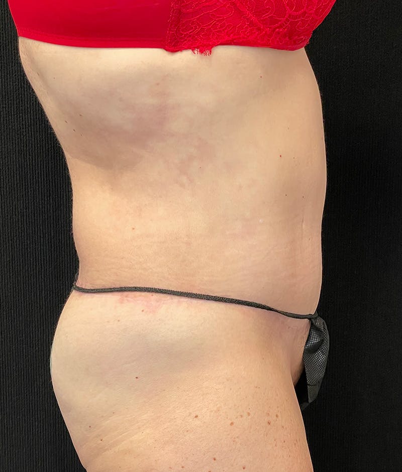 Lower Body Lift Before & After Gallery - Patient 210875 - Image 6