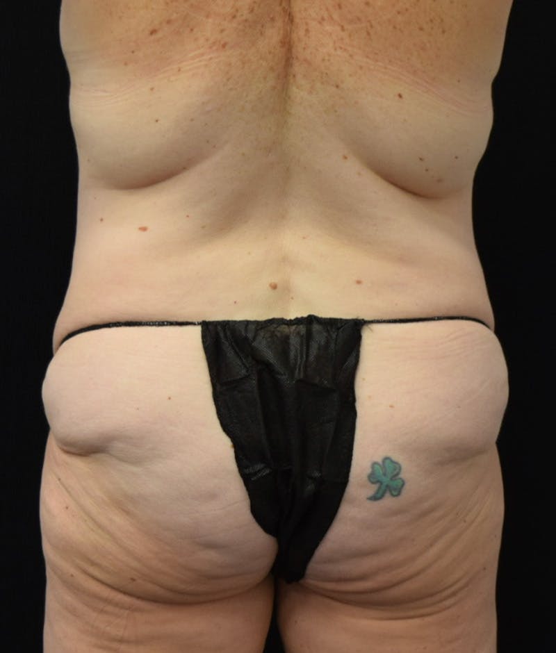 Lower Body Lift Before & After Gallery - Patient 210875 - Image 11