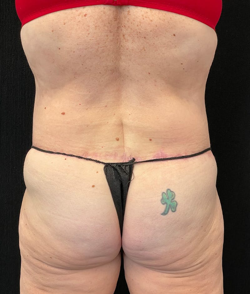 Lower Body Lift Before & After Gallery - Patient 210875 - Image 12